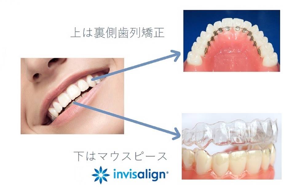 上は裏側歯列矯正、下はマウスピース