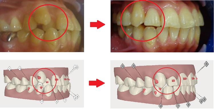 非抜歯治療例1.側面写真