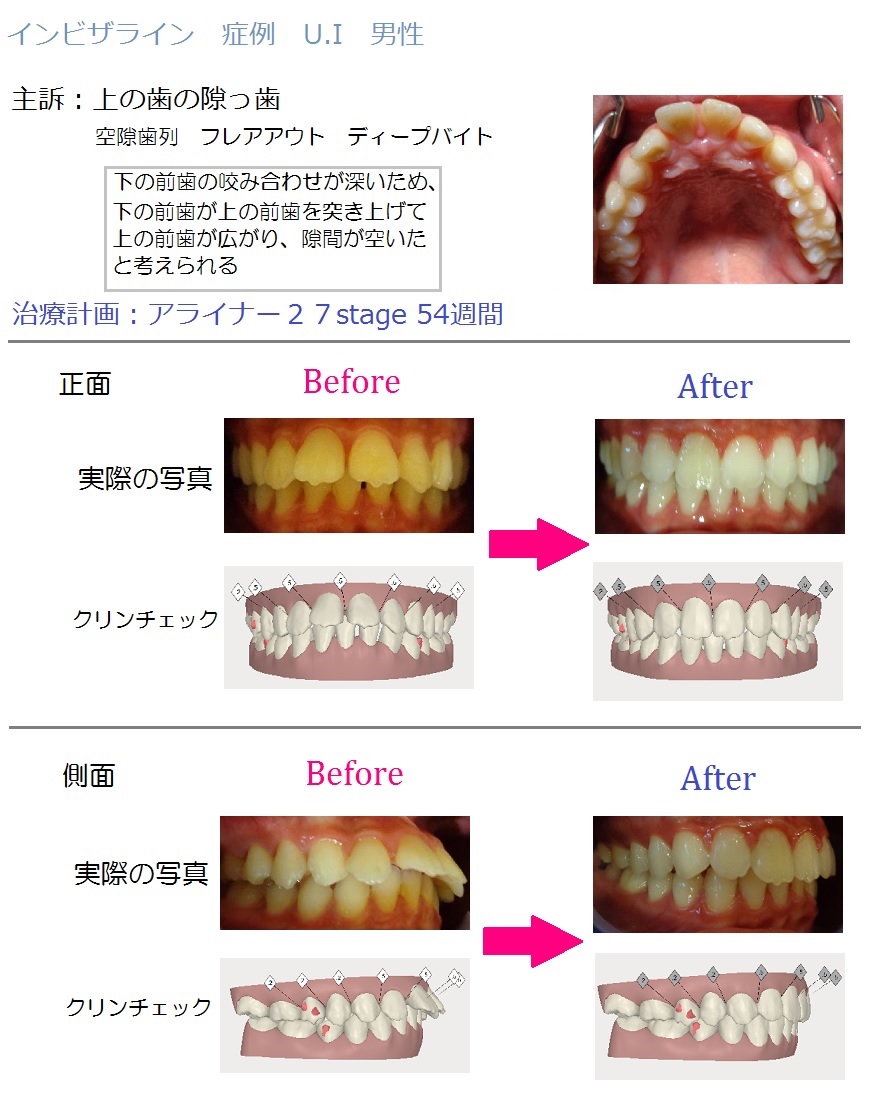 非抜歯治療例2.ビフォーアフター