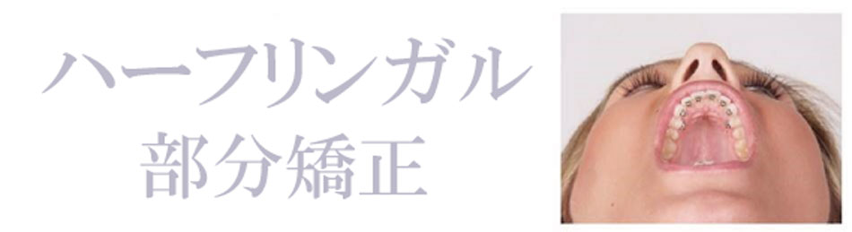 ハーフリンガル部分矯正