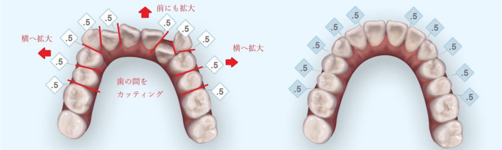 八重歯イメージ