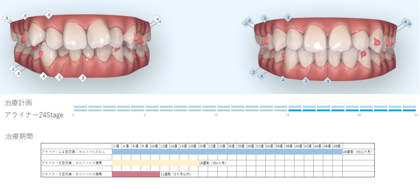 インビザライン・マウスピース矯正ならアライナー14日交換→3～5日交換に