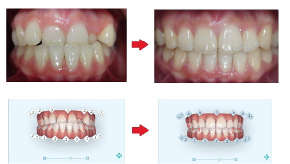 インビザラインでなるべく歯を抜かない修正