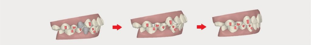 インビザラインの治療フローイメージ