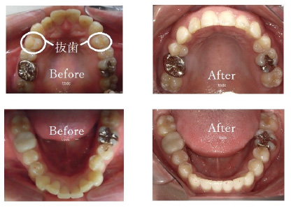 抜歯症例　ビフォーアフター