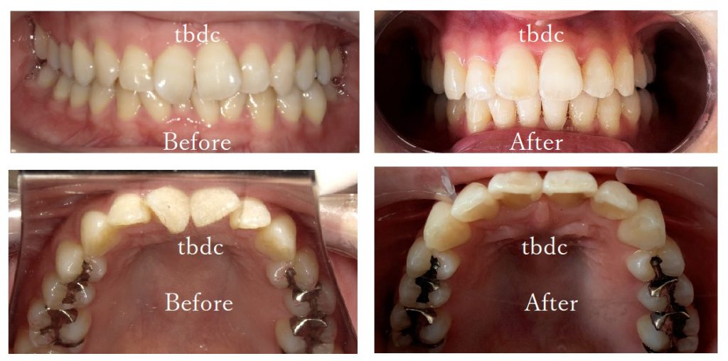 22歳女性のインビザライン症例画像