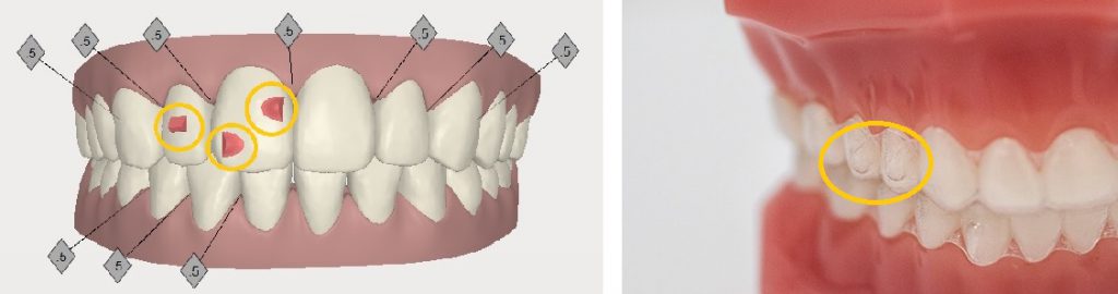 歯のコントロールで確実でキレイな歯並び