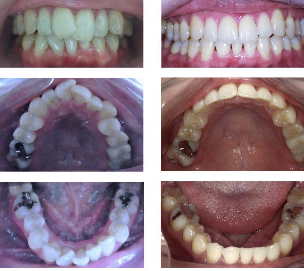 コラボ矯正の治療例：非抜歯