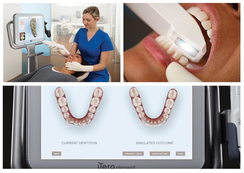患者様一人一人の歯列を読み取りデジタルデータ化できるi-Teroも活用します。