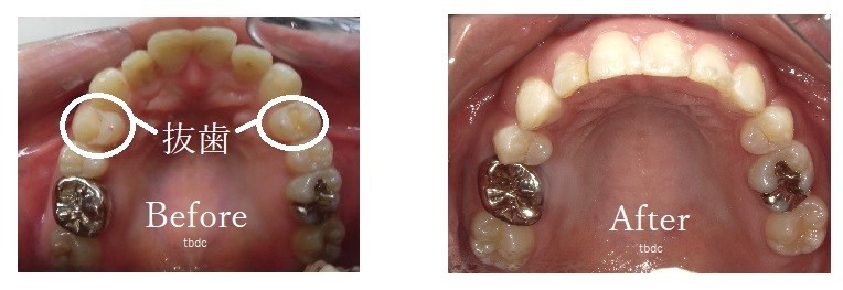 インビザラインによる抜歯矯正