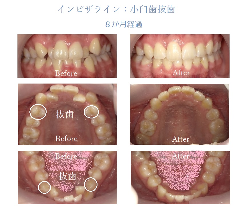インビザライン小臼歯抜歯の8ヶ月経過画像