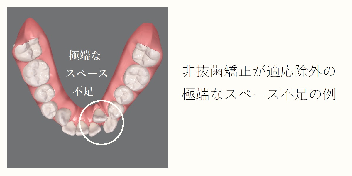 非抜歯矯正治療￼ 711-793x800.jpg